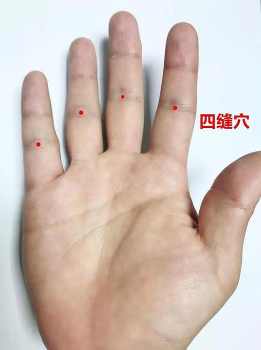 Les points sifeng (四缝 4 plis) sont un ensemble de quatre points curieux situés au centre des plis des articulations interphalangiennes proximales (IPP).