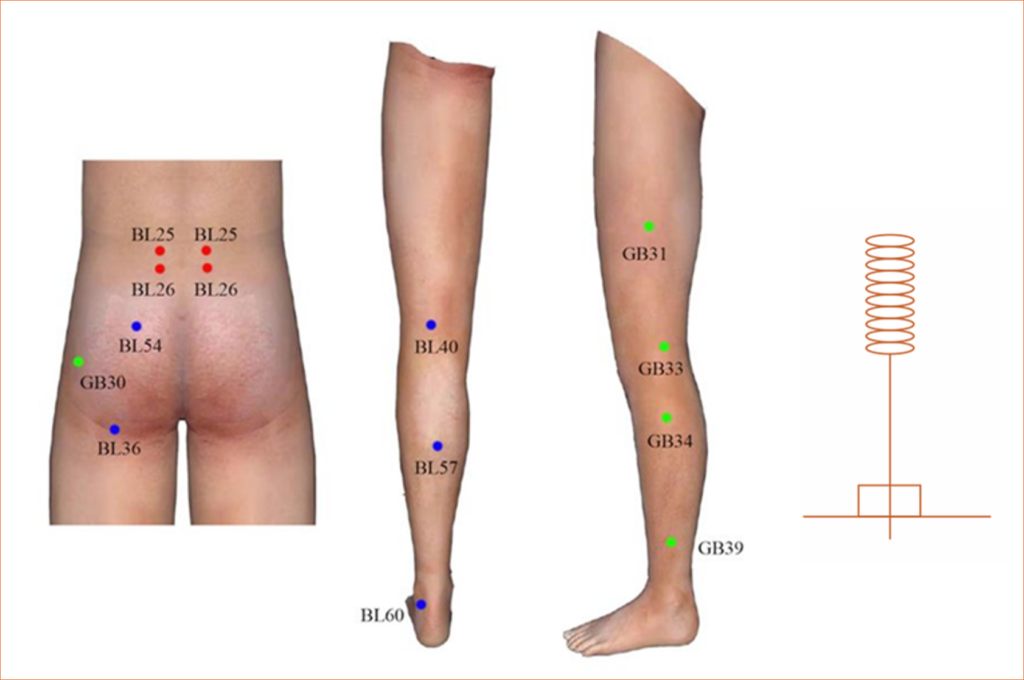 Protocole d'acupuncture pour le traitement par acupuncture de la sciatique. Les points.