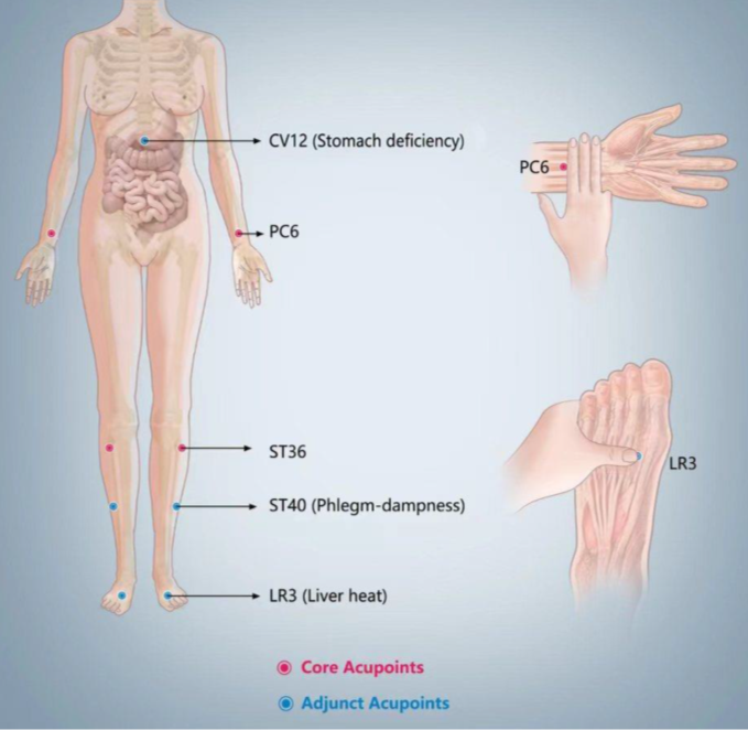 Points d'acupuncture pour le traitement par acupuncture pour les nausées et vomissements gravidiques.