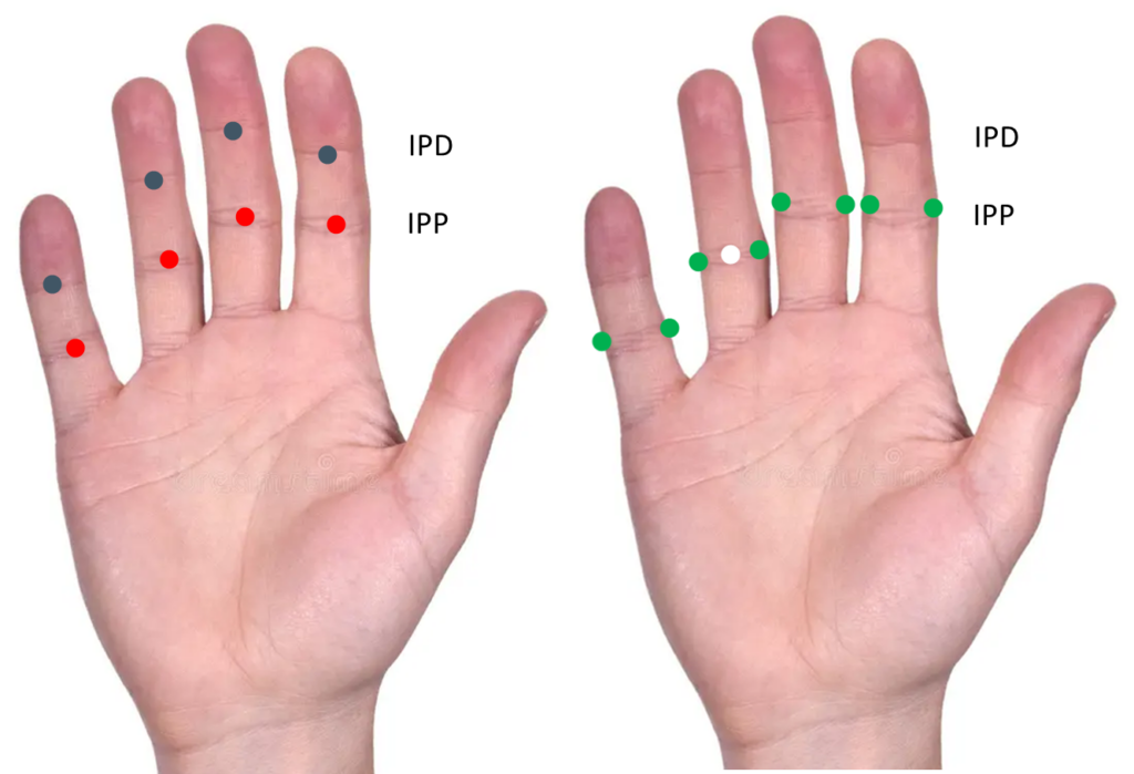 Principales variations de localisation des points sifeng. A gauche : 4 points au centre des plis, soit au niveau des IPP (interphalangiennes proximales), soit au niveau des IPD (interphalangiennes distales). A droite : 8 points aux extrémités médiales et latérales des IPP, ou 1 seul point au centre de l'IPP de l'annulaire.