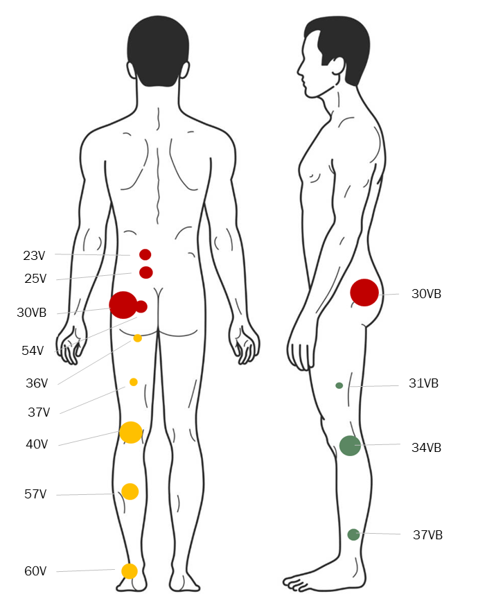 Traitement par acupuncture de la sciatique. Les 12 points les plus utilisés.