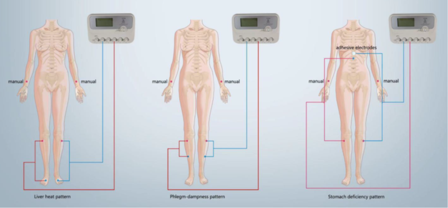 Electroacupuncture pour le traitement par acupuncture pour les nausées et vomissements gravidiques.