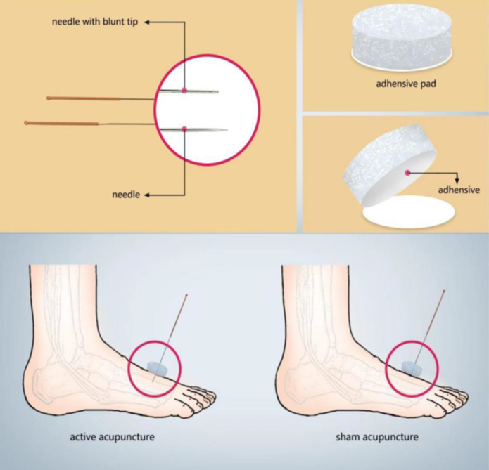 Modalité de la fausse acupuncture : aiguille à pointe émoussée et non pénétrante, base adhésive en mousse placé au niveau du point.