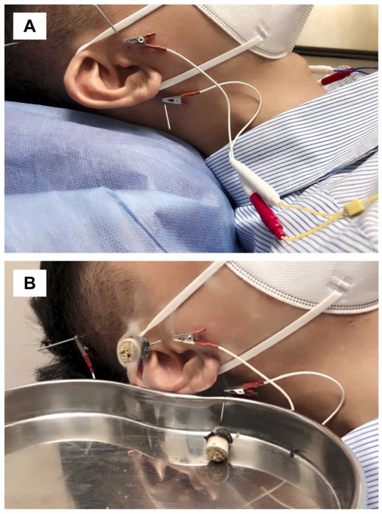 Figure 2 - Electroacupuncture et moxa sur aiguille