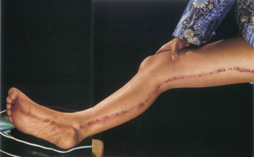Dermatose méridienne rein 8b